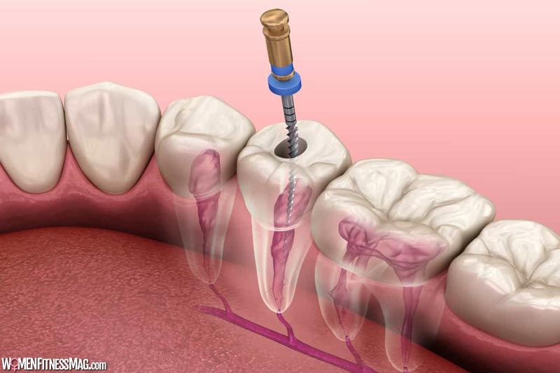 Root Canal Treatment